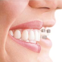 invisalign Madrid