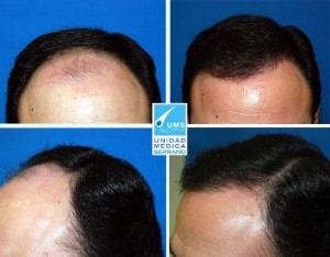 injertos de pelo